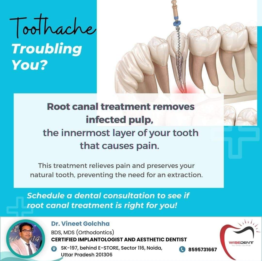 Root Canal Treatment 