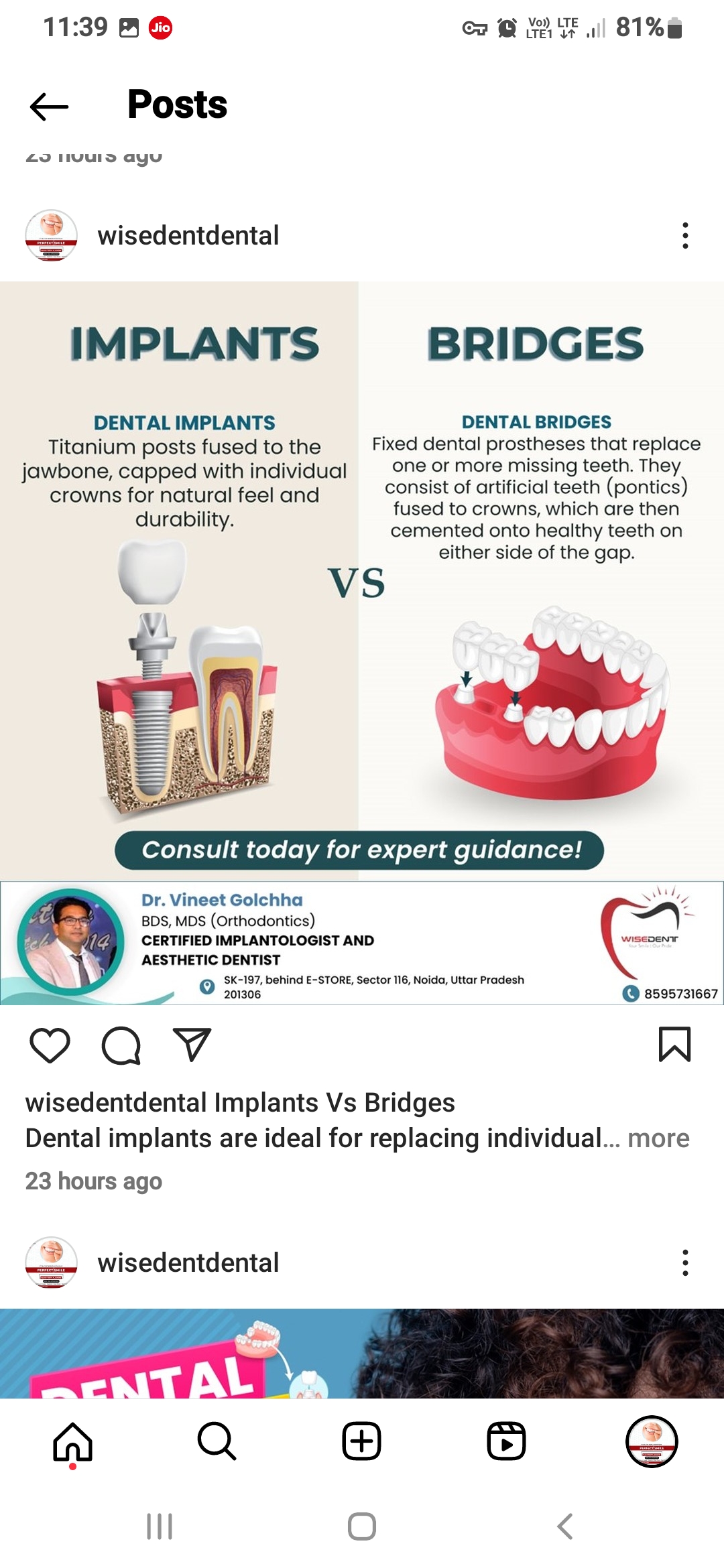 Implant vs Bridge