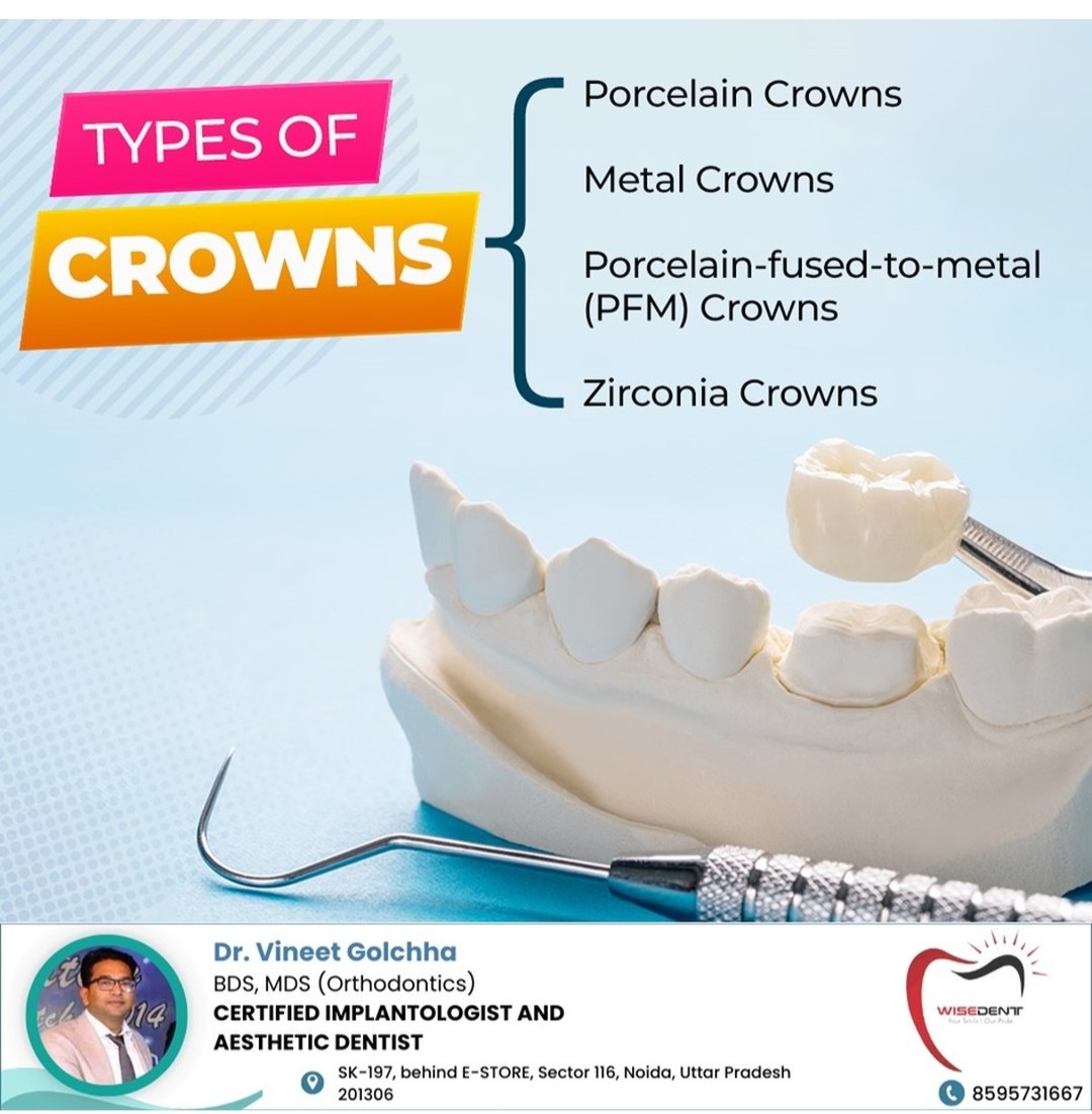 Types of crowns