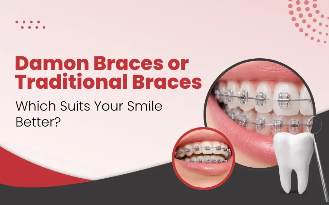 Damon Braces or Traditional Braces Which Suits Your Smile Better