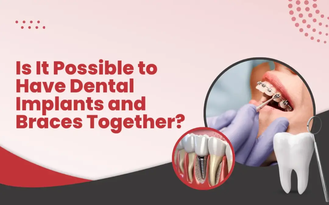 Is It Possible to Have Dental Implants and Braces Together
