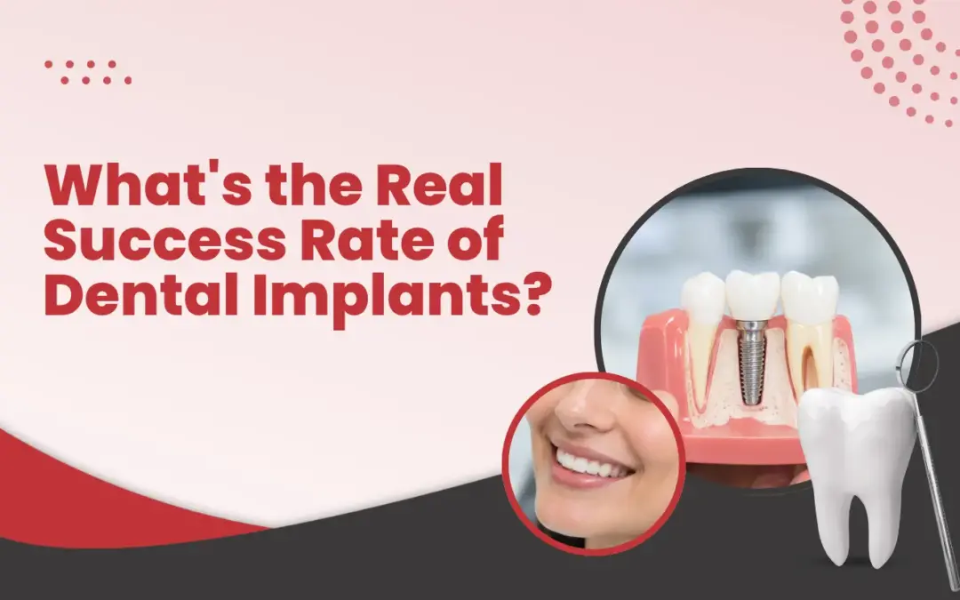What's the Real Success Rate of Dental Implants